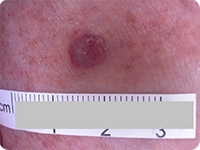 Nodular melanoma 