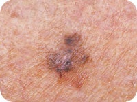 Borders in skin cancer