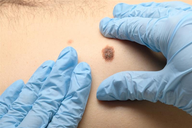 What are moles? | Cancer Council