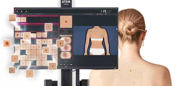 FotoFinder® with Moleanalyzer AI