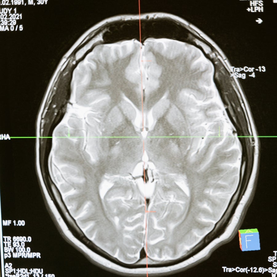MRI Scan of the brain 