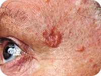 Basal cell carcinoma rounded