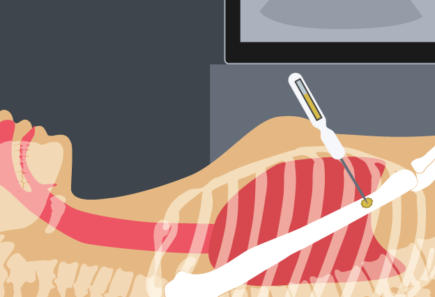 Illustration of skeleton having a Biopsy needle inserted in their bone.