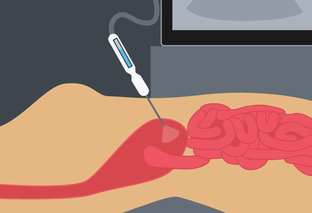 Illustration of tool being inserted in the peritoneum.