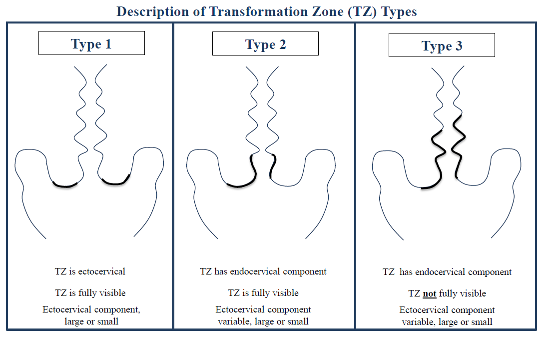 Description of TZ categories for Cervical Cancer Guidelines