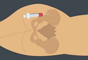 Illustration of needle inserted into pelvic bone.