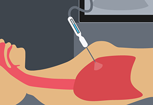 Illustration of needle inserted in lung.