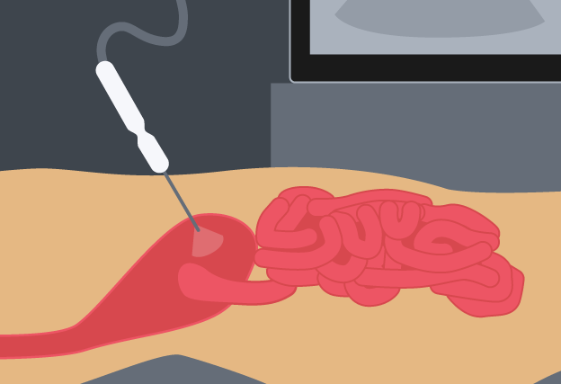 Illustration of a diagnostic tool being inserted into the abdomen.