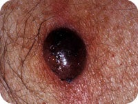 Thick modular melanoma rounded 