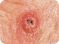 Squamous cell carcinoma rounded
