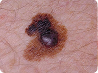 Evolving melanoma