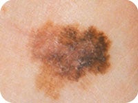 Asymmetry in skin cancer