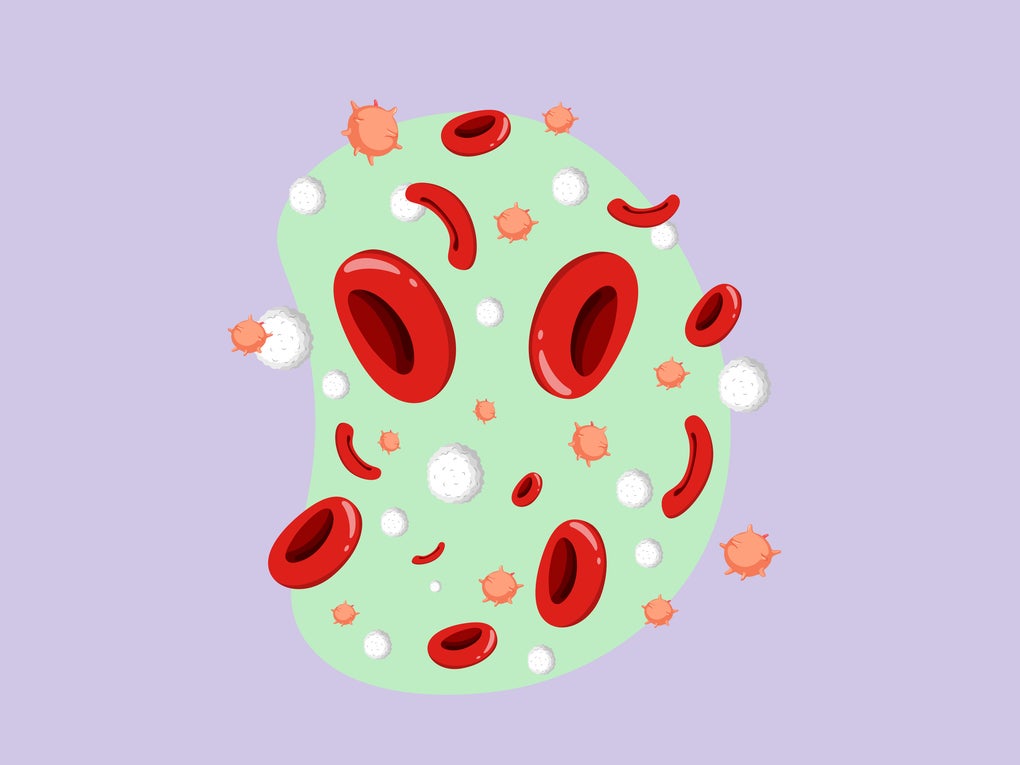 Sickle Cells  Sickle Cells