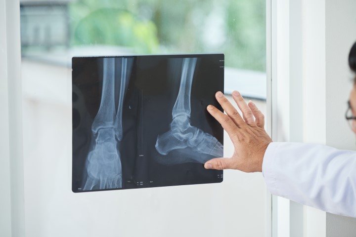 Doctor showing x-ray of ankle